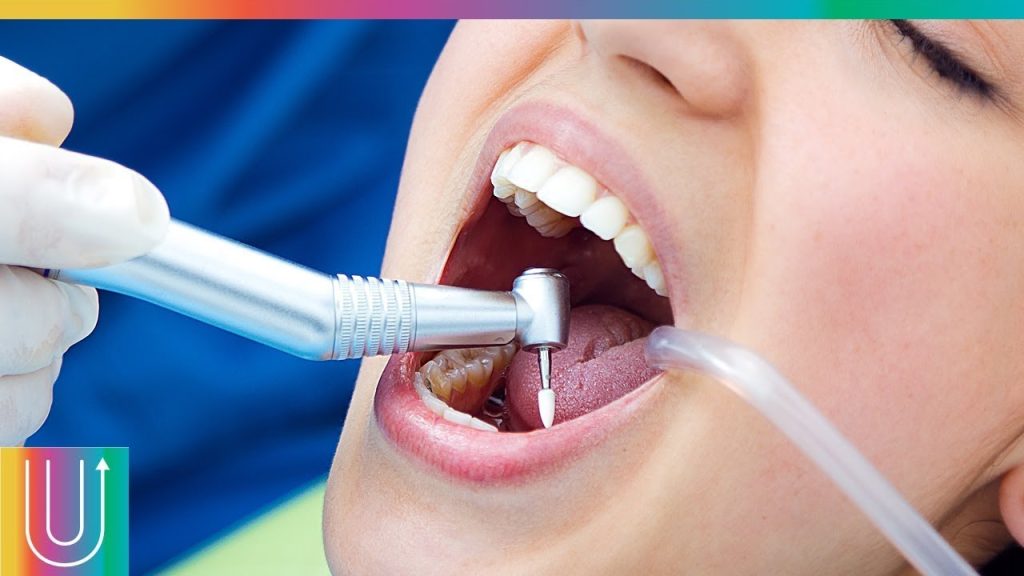 Cómo rellenar las caries