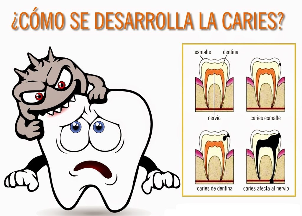 Qué es la caries dental