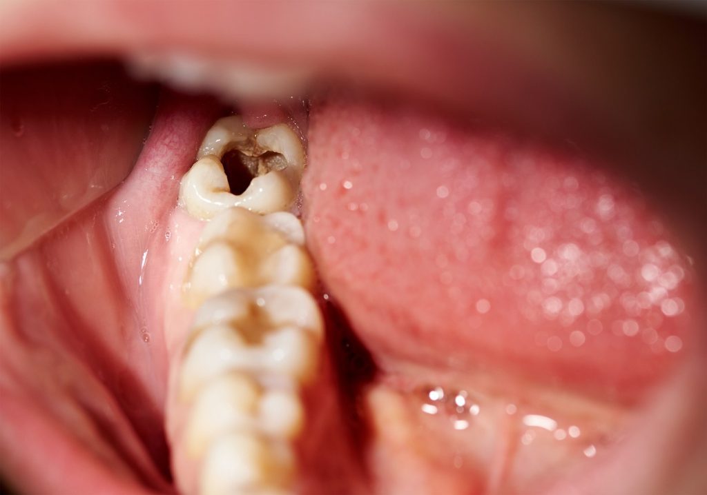 Qué personas son más propensas a tener caries