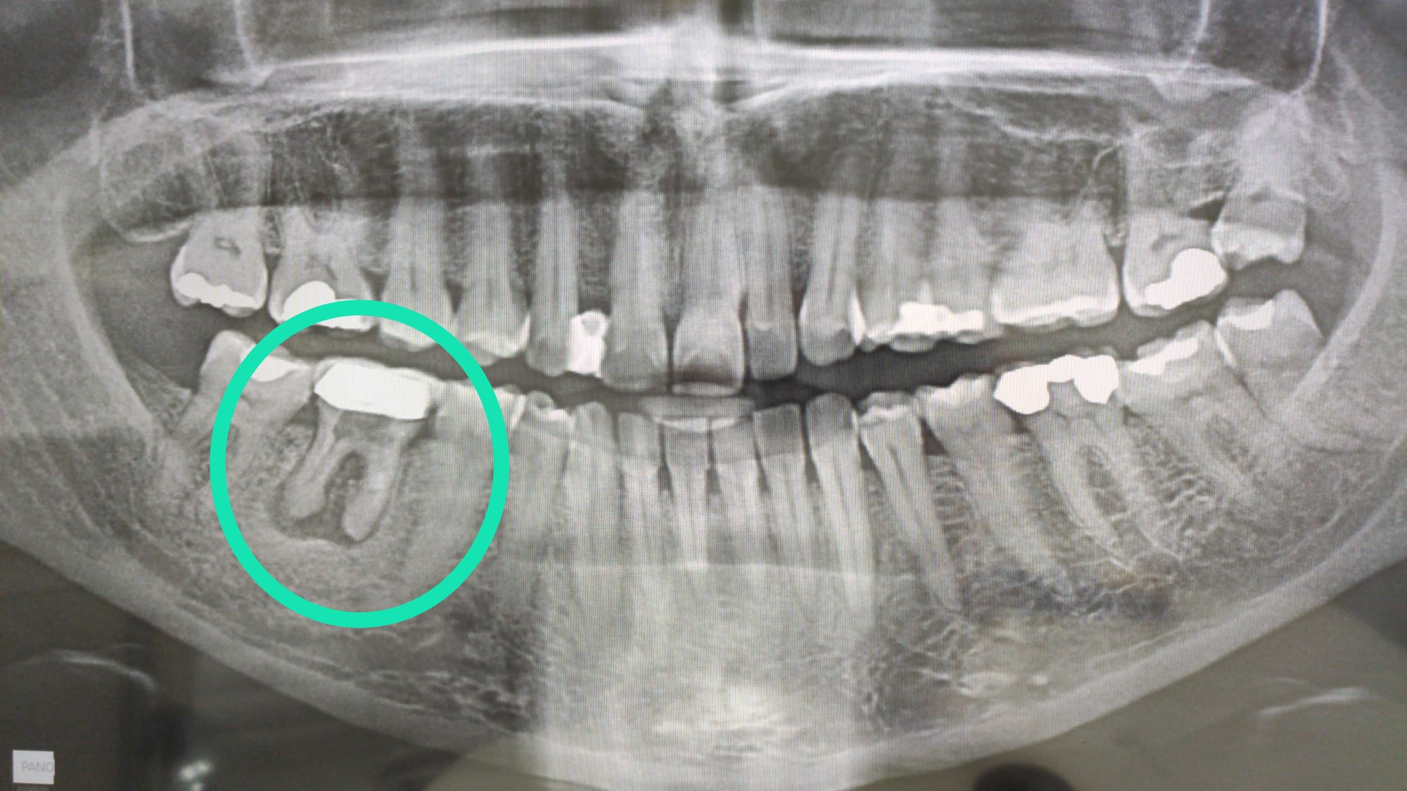Que se puede comer cuando se tiene un absceso dental Urgencias dentales