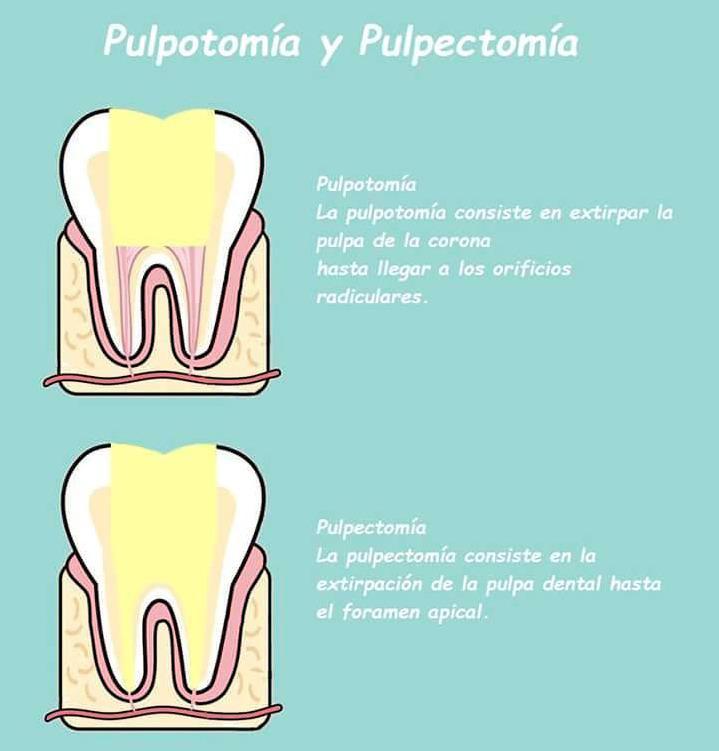 Qué diferencia hay entre pulpectomía y pulpotomía